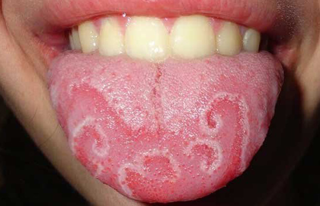 Ağızda acılıq foto 4